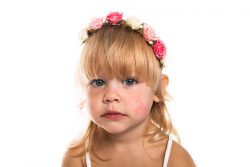 Диатез у детей: причины и лечение