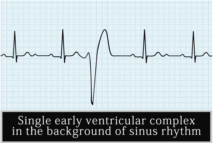 Экстрасистолия: причины, симптомы, лечение