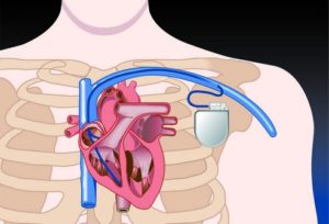 Синдром слабости синусового узла СССУ что это