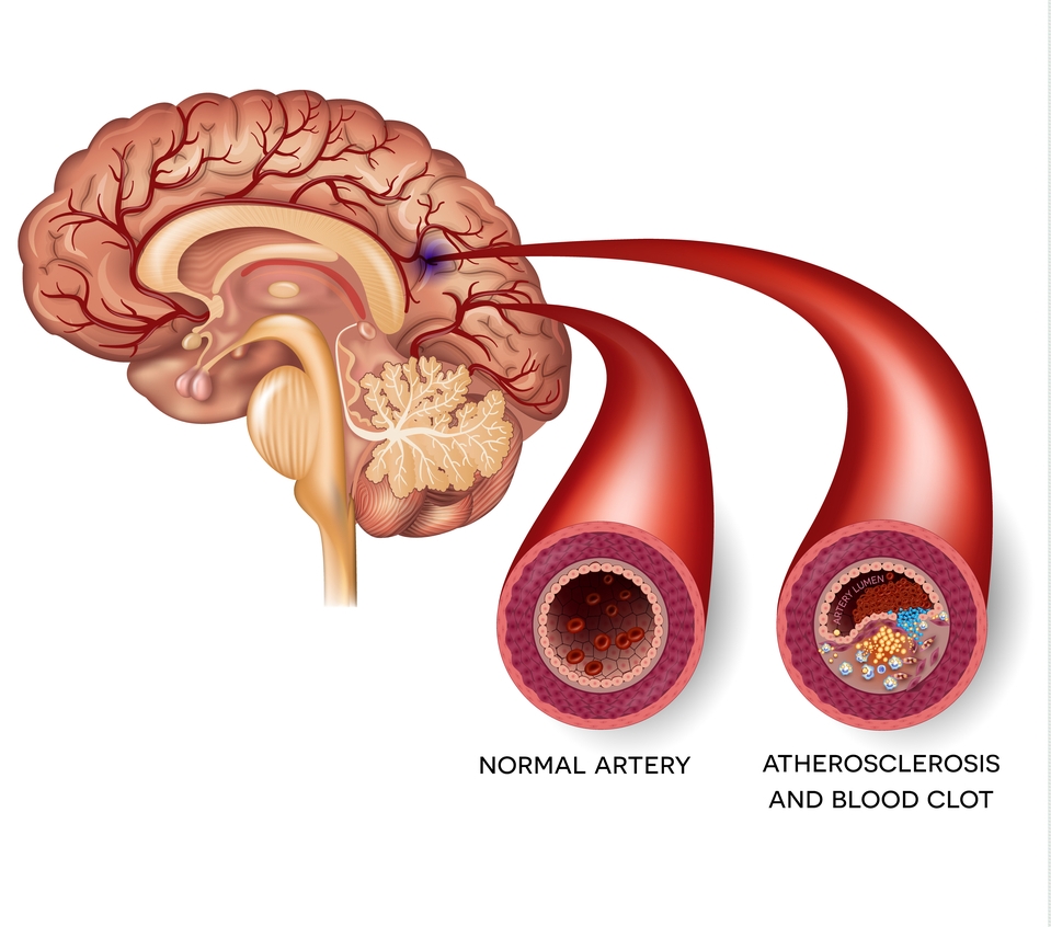 Атеросклероз сосудов головного мозга: причины и симптомы