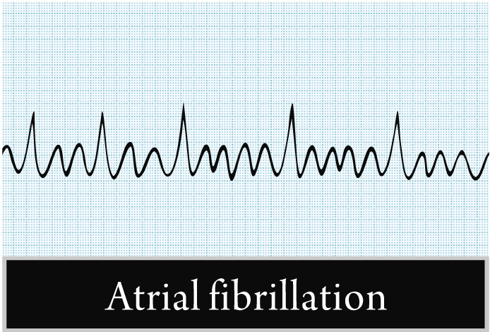 Мерцательная аритмия: симптомы, причины