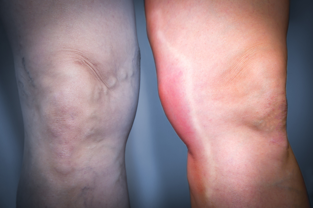 Диагностика и лечение тромбофлебита нижних конечностей