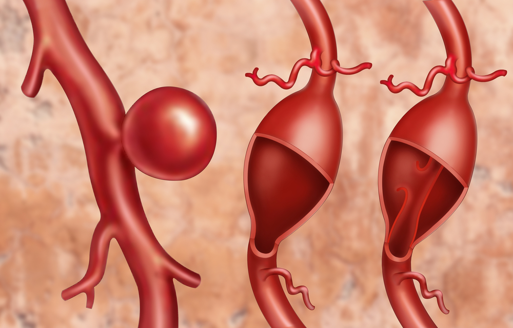 Аневризма аорты: симптомы и лечение