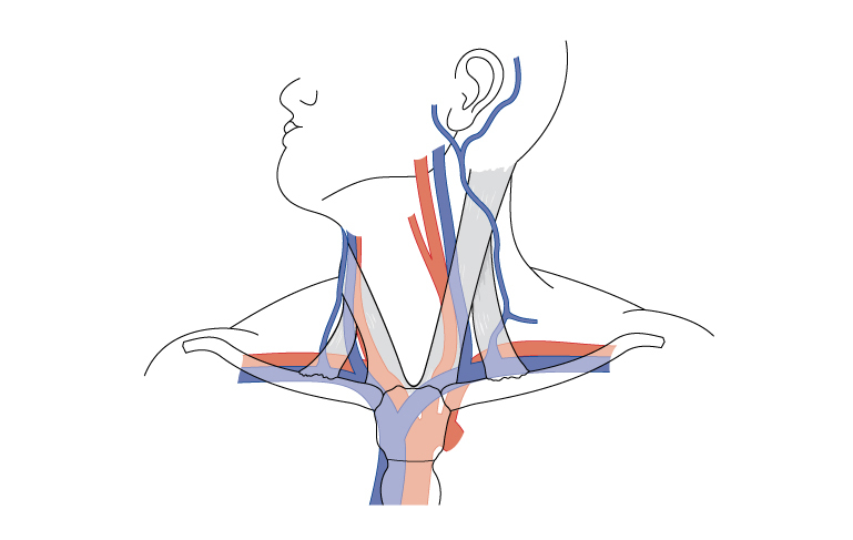 Окклюзия подключичной артерии: почему возникает и как лечить