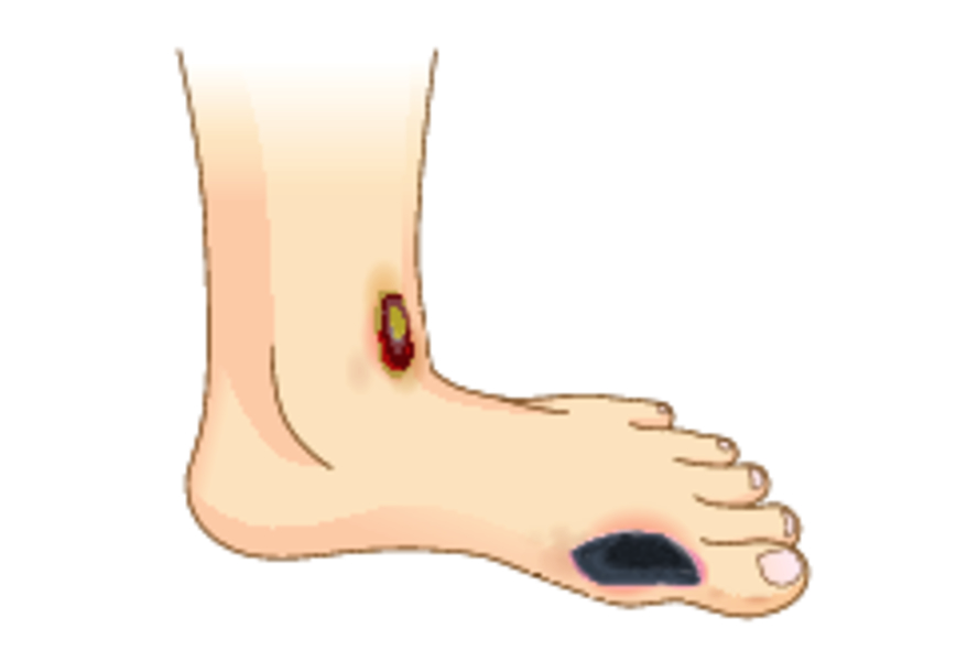 Ишемическая диабетическая стопа: симптомы и лечение