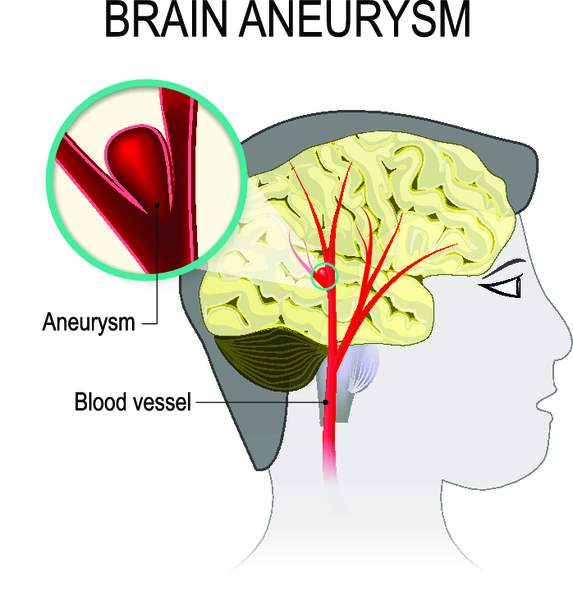 Аневризма сосудов головного мозга: симптомы, принципы лечения