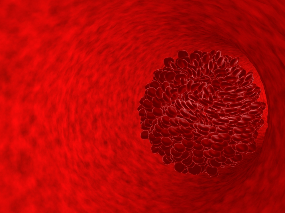 Острый венозный тромбоз: стадии, симптомы, лечение