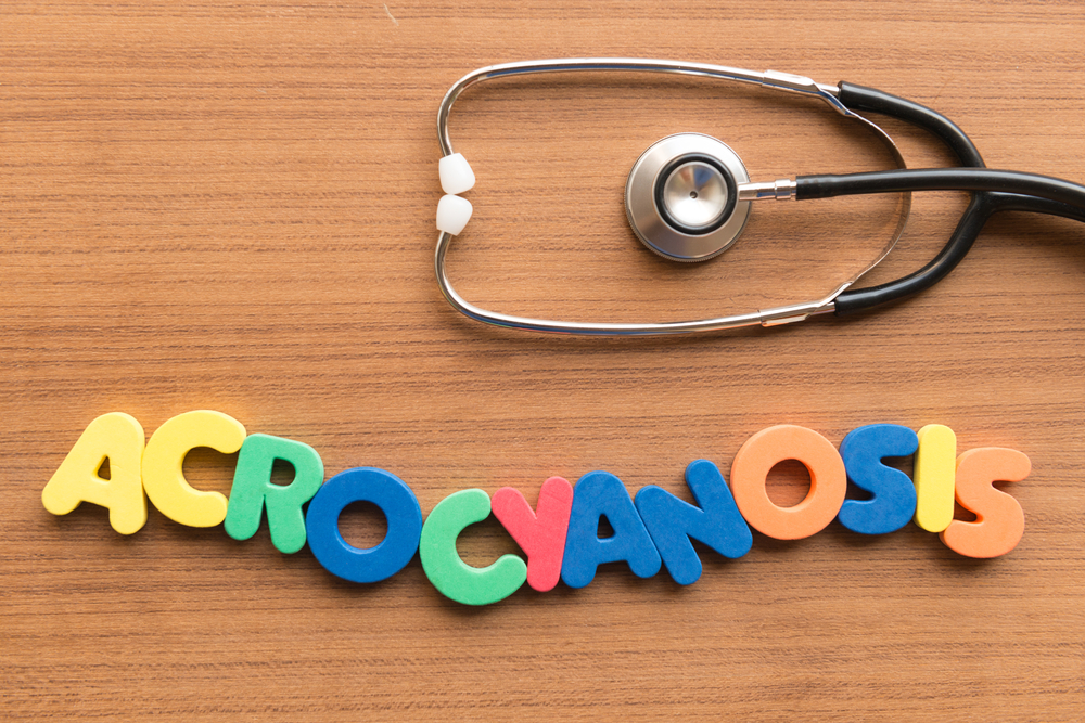 Акроцианоз: что это, почему и при каких болезнях возникает