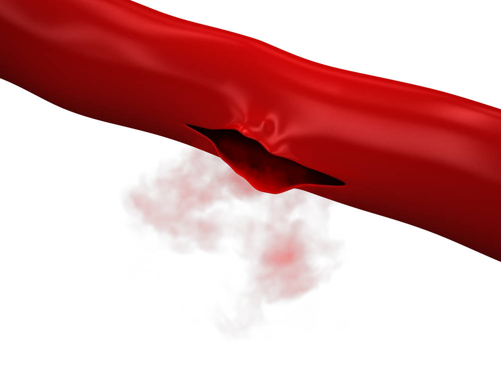 Разрыв аорты: причины, симптомы, прогноз