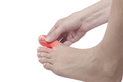 Лечение подагры в домашних условиях