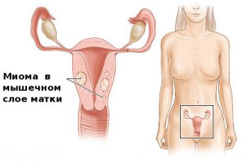 миома матки