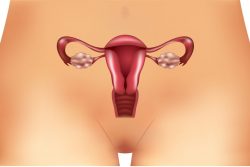 Как лечить поликистоз яичников?