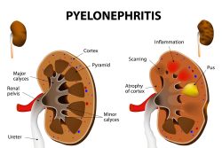 Пиелонефрит у детей: симптомы и лечение
