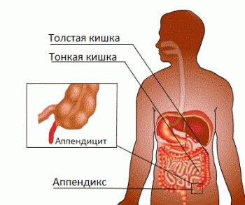 аппендицит