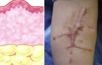 келоидные рубцы