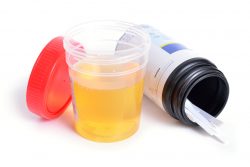 Ацетон в моче у ребенка: причины, симптомы, лечение, диета