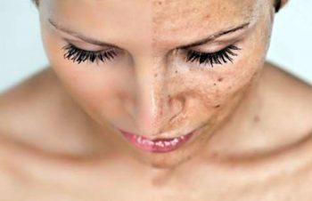 Пигментные пятна на лице: причины, лечение