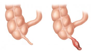 Аппендицит у детей: симптомы, причины и лечение