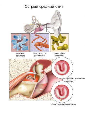 Отит у детей: симптомы и лечение