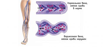 Профилактика венозных заболеваний: советы и рекомендации