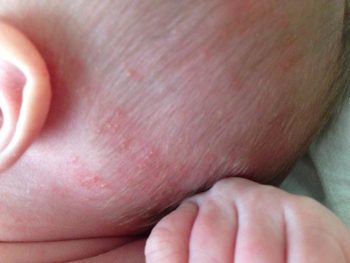 Везикупустулез новорожденных: симптомы и лечение