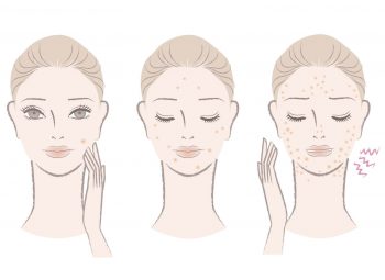 Системная красная волчанка: симптомы и лечение