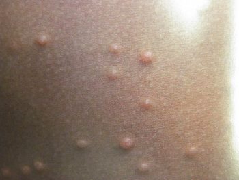 Контагиозный моллюск