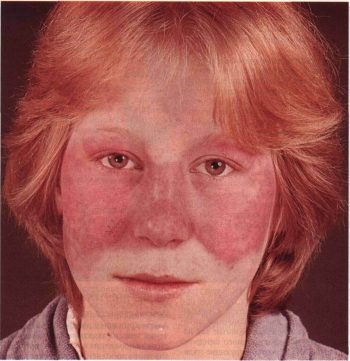 Системная красная волчанка: симптомы и лечение