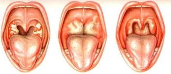 Дифтерия у взрослых: причины, симптомы, диагностика, лечение и профилактика