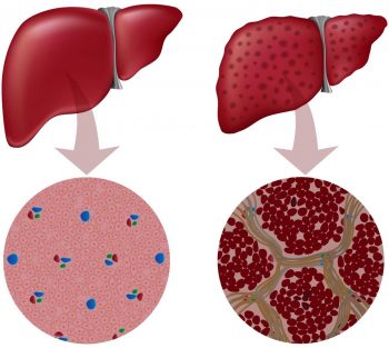 Лечение увеличенной печени
