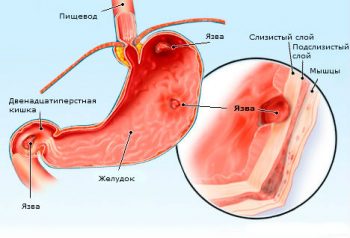 Что делать при резкой боли в желудке? Возможные причины