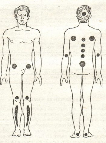 Как правильно лечить пролежни?