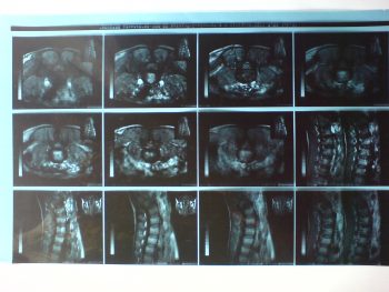 Болезнь Бехтерева: симптомы и лечение
