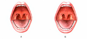 Дифтерия у детей: симптомы и лечение