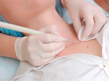 Себорейный кератоз: причины и лечение