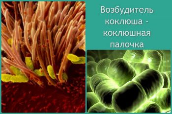 Коклюш у детей: симптомы и лечение