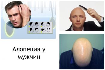 Андрогенная алопеция у мужчин: причины и лечение
