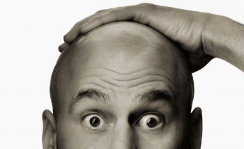 Андрогенная алопеция у мужчин: причины и лечение