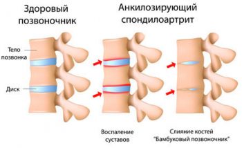 Лечебная физкультура Основным методом лечения функциональной недостаточности суставов является регулярная физическая нагрузка. Каждому пациенту врач ЛФК подбирает комплекс упражнений в соответствии с формой и стадией его заболевания. Лечебной гимнастикой нужно заниматься 1-2 раза в день, по 20-30 минут. В период ремиссии положительное действие оказывают плавание и ходьба на лыжах.