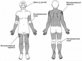 Фолликулярный кератоз: причины и лечение