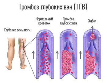 Антифосфолипидный синдром: диагностика и лечение