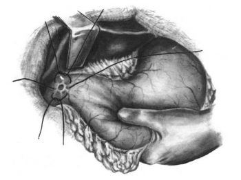 Прободная язва желудка: причины, симптомы и лечение