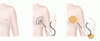 гинекомастия