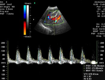 УЗИ сердца, или Эхокардиография: что это и для чего используется?
