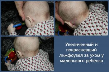 Причины воспаления лимфоузлов