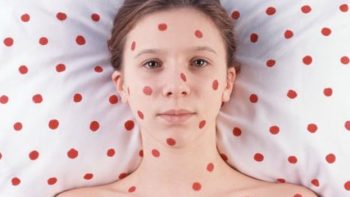 Корь у детей: профилактика и лечение