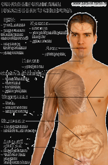 Рассеянный склероз: симптомы и лечение