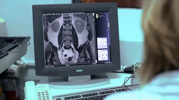 Компрессионный перелом позвоночника: лечение и реабилитация