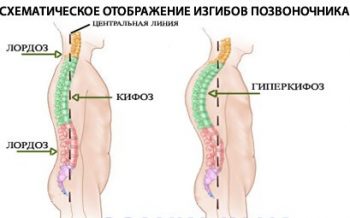 Лордоз: причины, симптомы и лечение