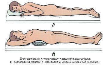 Компрессионный перелом позвоночника: лечение и реабилитация